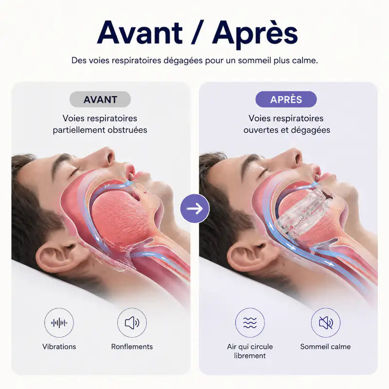Comparatif avant et après montrant l’effet d’une gouttière anti-ronflement sur l’ouverture des voies respiratoires afin de favoriser une respiration plus fluide pendant le sommeil.