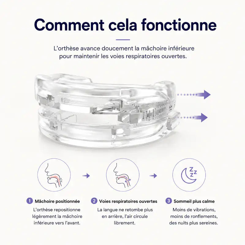 Schéma illustrant le fonctionnement d’une gouttière anti-ronflement qui avance légèrement la mâchoire inférieure afin de maintenir les voies respiratoires ouvertes pendant le sommeil.